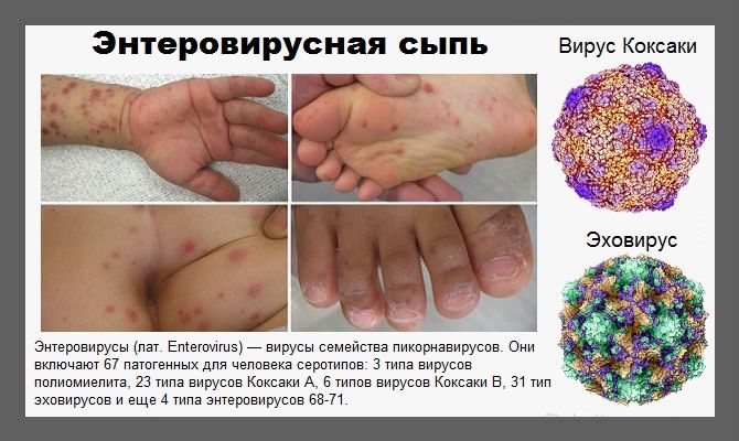 Ротавирусная инфекция, лечение