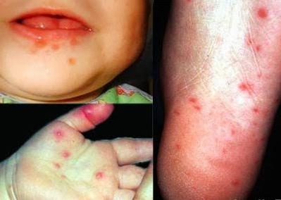 Энтеровирусная инфекция у детей